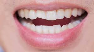 Read more about the article Can a Chipped Tooth Lead to Infection? 6 Signs to Watch for in Marsden Park