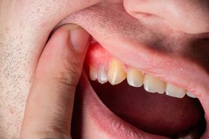 Read more about the article How to Treat Gum Swelling: Effective Remedies & Tips