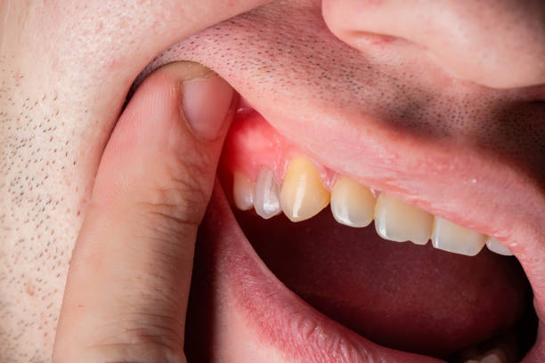 You are currently viewing How to Treat Gum Swelling: Effective Remedies & Tips